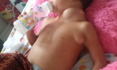 Ayahnya Meninggal 5 Hari Lalu, Balita Malang Ini Dilarikan ke RSUD Akibat Menderita Kelenjar Getah Bening