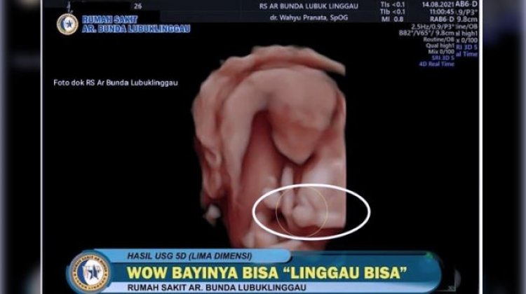 Viral Foto USG Bayi Berpose Acungi Jempol Simbol 'Oke', Wali Kota Lubuklinggau: Cukup Terkejut