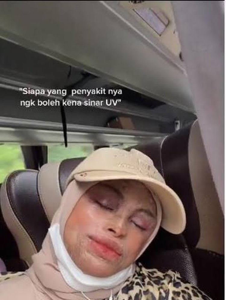 Viral! Gadis Pariaman-Sumbar Ini Dilarang Kena Sinar UV, Ini Alasannya
